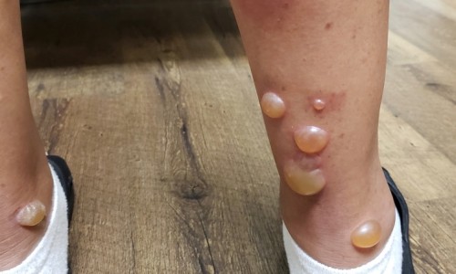 哺乳期发现胳肢窝长了个小硬包疼-哺乳期发现胳肢窝长了个小硬包网- 哺乳期发现胳肢窝长了个小硬包怎么回事知识,分享哺乳期胳膊窝有硬块